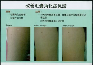 毛孔角化症 Keratosis pilaris 治療